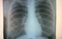 рентген легких расшифровка?