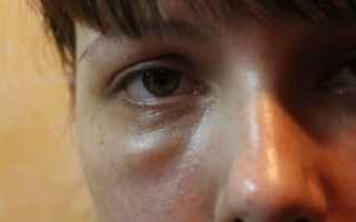 Отек левой части лица