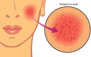 Массаж лица при куперозе