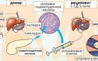 Трансплантация островковых клеток в качестве одного из способов лечения сахарного диабета