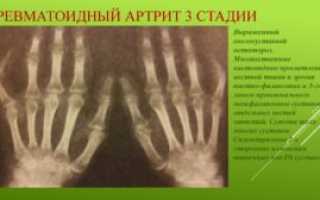 Ревматоидный артрит и остеопороз