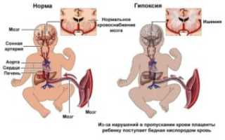 Симптомы болезни — нарушения маточно плацентарного кровотока