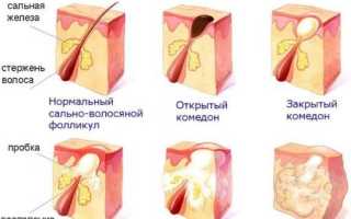 Комедоны на лице как избавиться