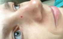 Как избавиться от лопнувших капилляров на лице