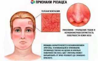 Как лечить розацеа