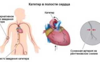 Катетеризация сердца