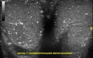 Гипертрофия яичка, возможность лечения!