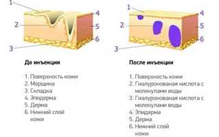 Гиалуроновая кислота для кожи