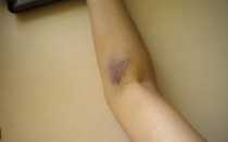 болит рука после укола