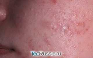 Закрытые комедоны на лбу