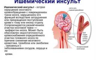 Ишемический инсульт головного мозга