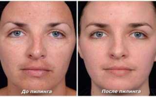 Что нельзя делать после чистки лица