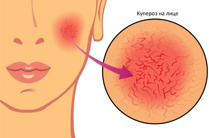 Массаж лица при куперозе